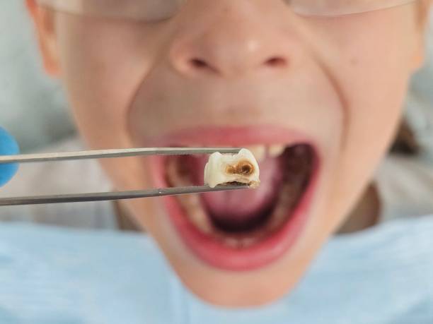 Best Emergency Dental Care for Broken or Chipped Teeth in Lake Wynonah, PA